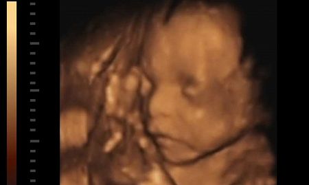 Angie was laughing before her ninth abortion. Then she saw the aborted baby