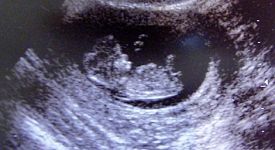 WOMAN PRESCRIBED ABORTION PILLS HAD LIFE-THREATENING ECTOPIC PREGNANCY
