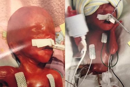The world's most premature twins, born in Iowa, defy the odds and turn 1