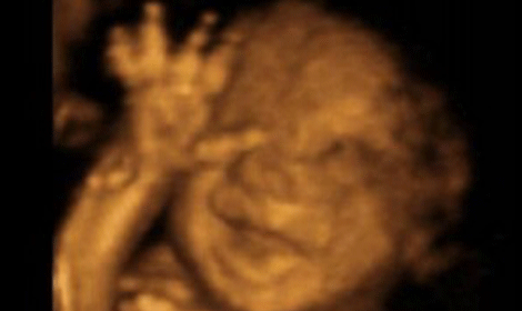 Mom told to take abortion pills to remove ‘miscarried’ baby asks for second scan: finds baby alive